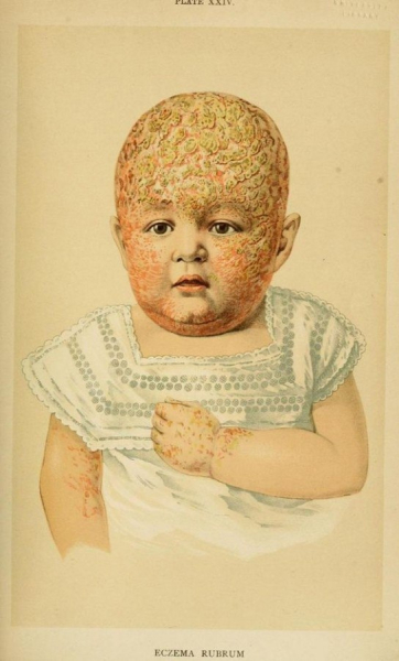 Одна из форм детской мокнущей экземы, eczema rubrum. Иллюстрация из..0