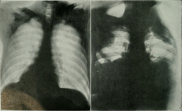 Из американского журнала рентгенологии, радиотерапии и ядерной..5