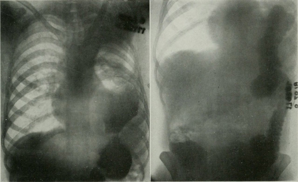 Из американского журнала рентгенологии, радиотерапии и ядерной..0