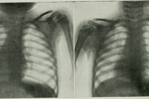 Из американского журнала рентгенологии, радиотерапии и ядерной..3