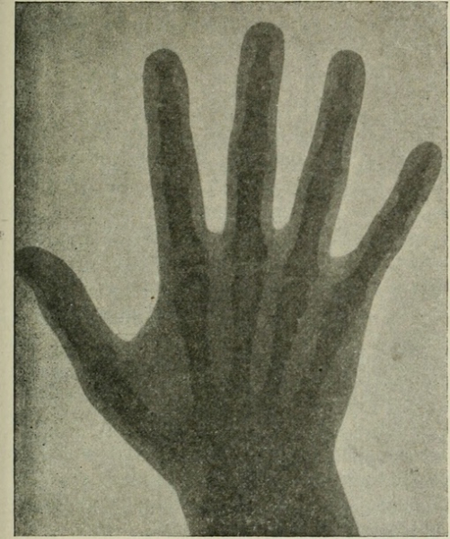 Из американского журнала рентгенологии, радиотерапии и ядерной..1