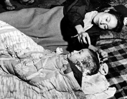 Мать ухаживает за ребёнком, пострадавшим от взрыва атомной..0