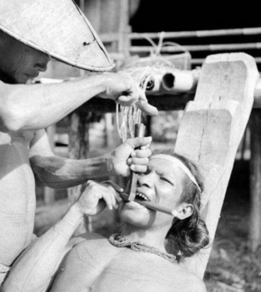 Заточка зубов у племен Индонезии и её последствия: фотографии 1938..0