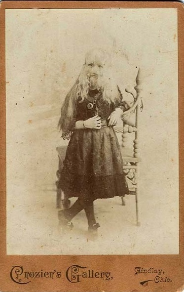Алиса Элизабет Доэрти (1887 г.): девочка с врождённым гипертрихозом,..4