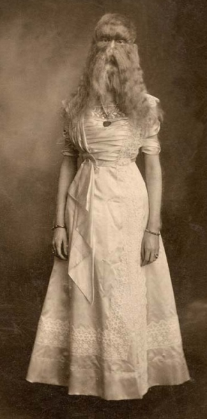 Алиса Элизабет Доэрти (1887 г.): девочка с врождённым гипертрихозом,..3