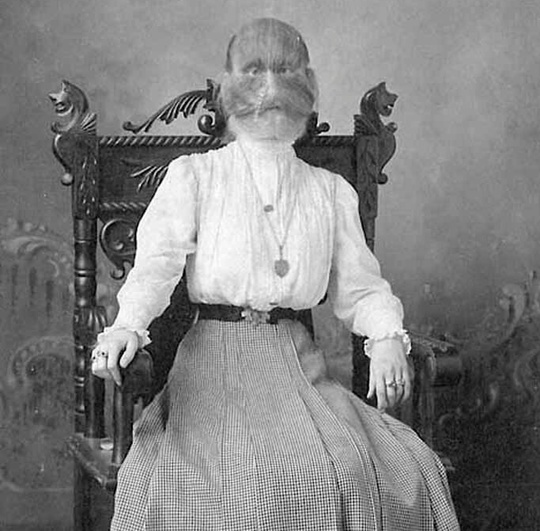 Алиса Элизабет Доэрти (1887 г.): девочка с врождённым гипертрихозом,..1
